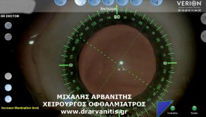 Επέμβαση καταρράκτη